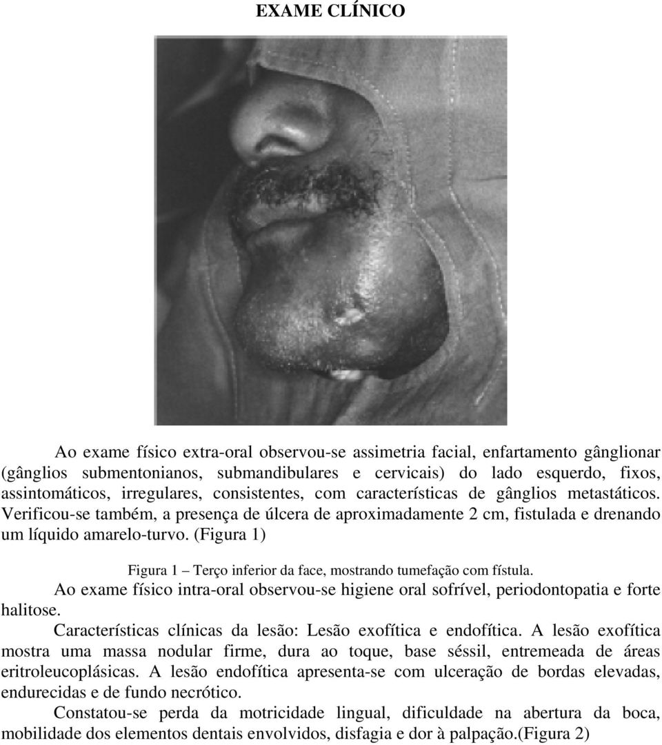 (Figura 1) Figura 1 Terço inferior da face, mostrando tumefação com fístula. Ao exame físico intra-oral observou-se higiene oral sofrível, periodontopatia e forte halitose.