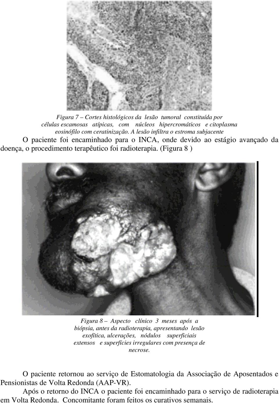 (Figura 8 ) Figura 8 Aspecto clínico 3 meses após a biópsia, antes da radioterapia, apresentando lesão exofítica, ulcerações, nódulos superficiais extensos e superfícies irregulares com presença de