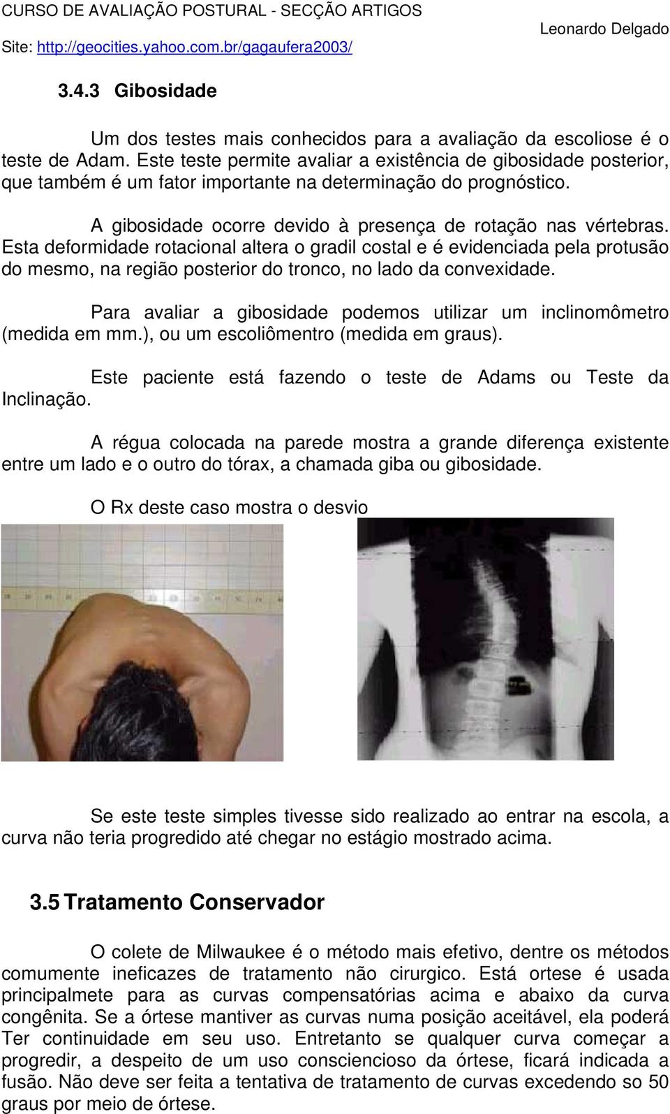 Esta deformidade rotacional altera o gradil costal e é evidenciada pela protusão do mesmo, na região posterior do tronco, no lado da convexidade.