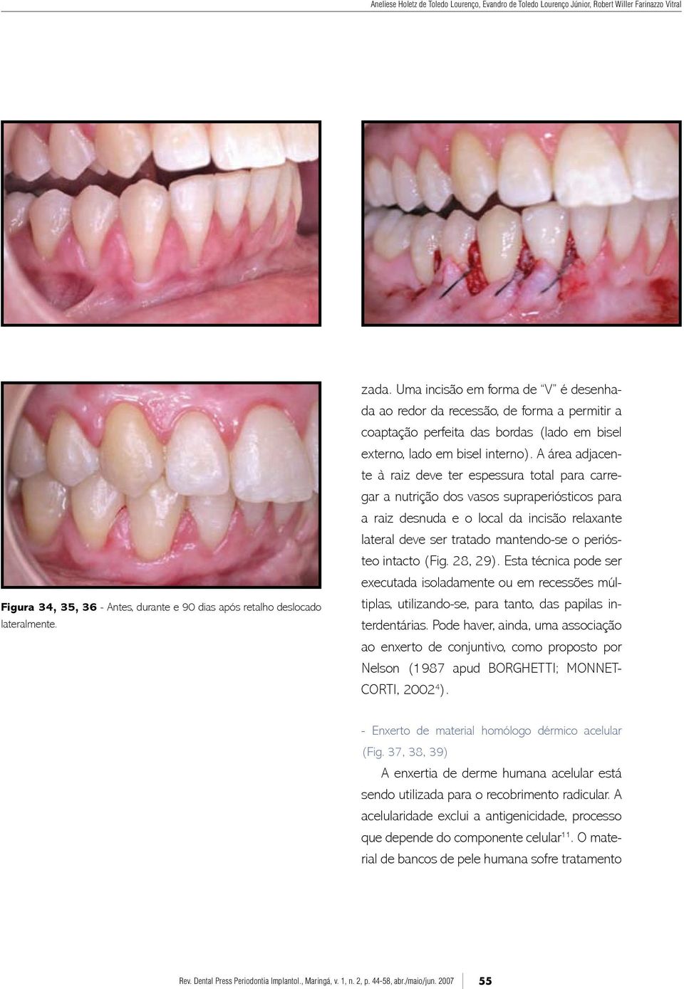 A área adjacente à raiz deve ter espessura total para carregar a nutrição dos vasos supraperiósticos para a raiz desnuda e o local da incisão relaxante lateral deve ser tratado mantendo-se o