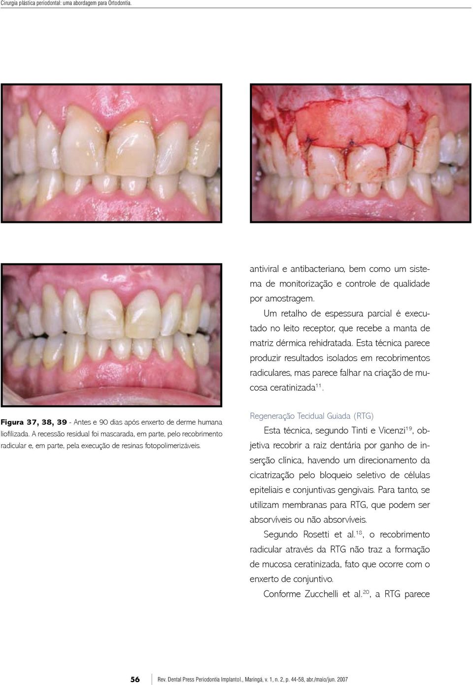 Esta técnica parece produzir resultados isolados em recobrimentos radiculares, mas parece falhar na criação de mucosa ceratinizada 11.