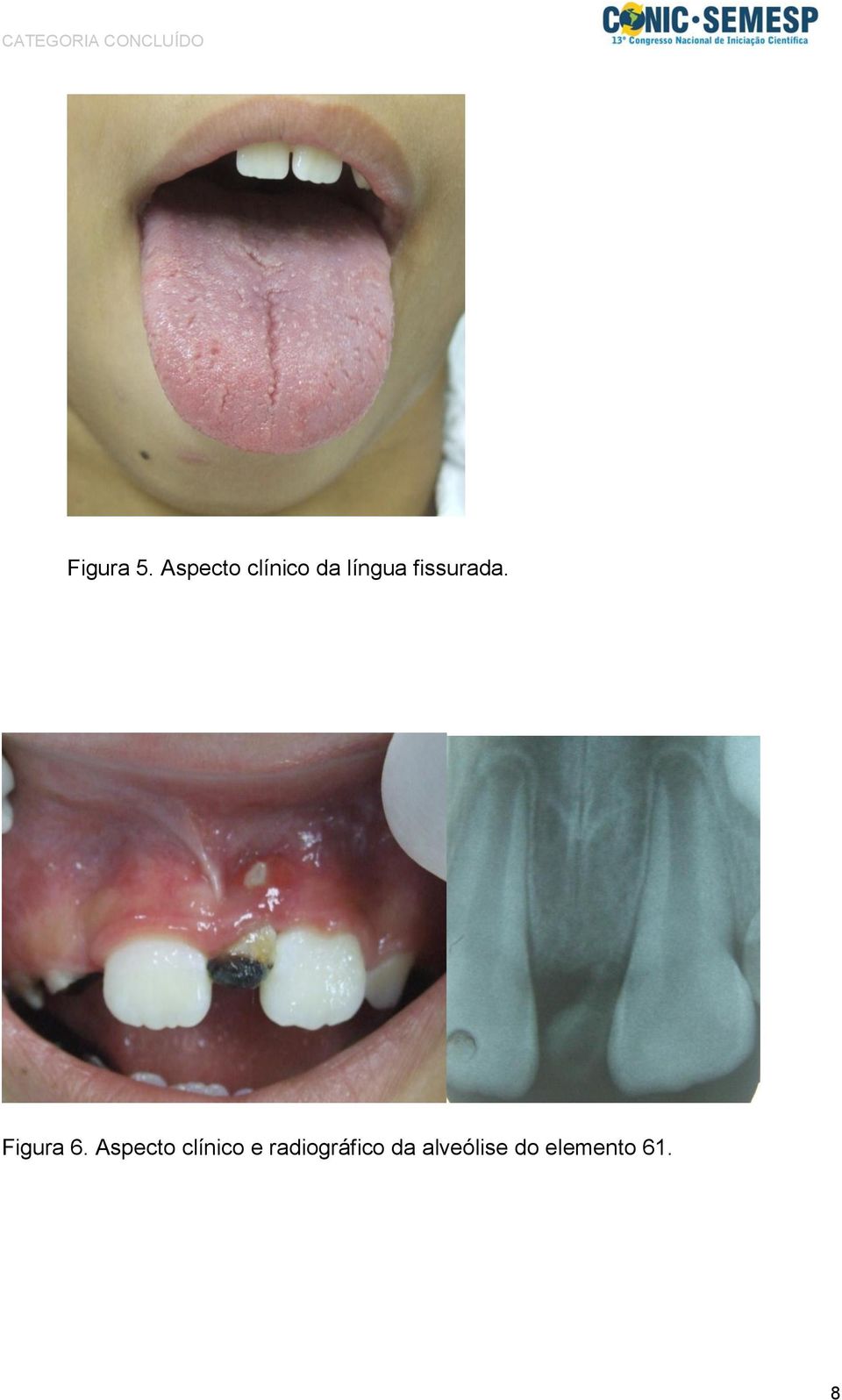 fissurada. Figura 6.