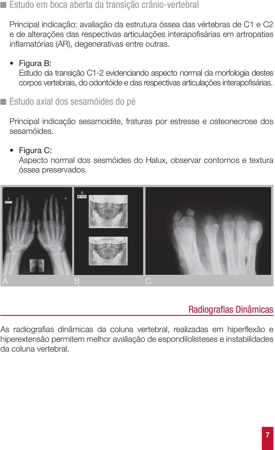 Figura B: Estudo da transição C1-2 evidenciando aspecto normal da morfologia destes corpos vertebrais, do odontóide e das respectivas articulações interapofisárias.