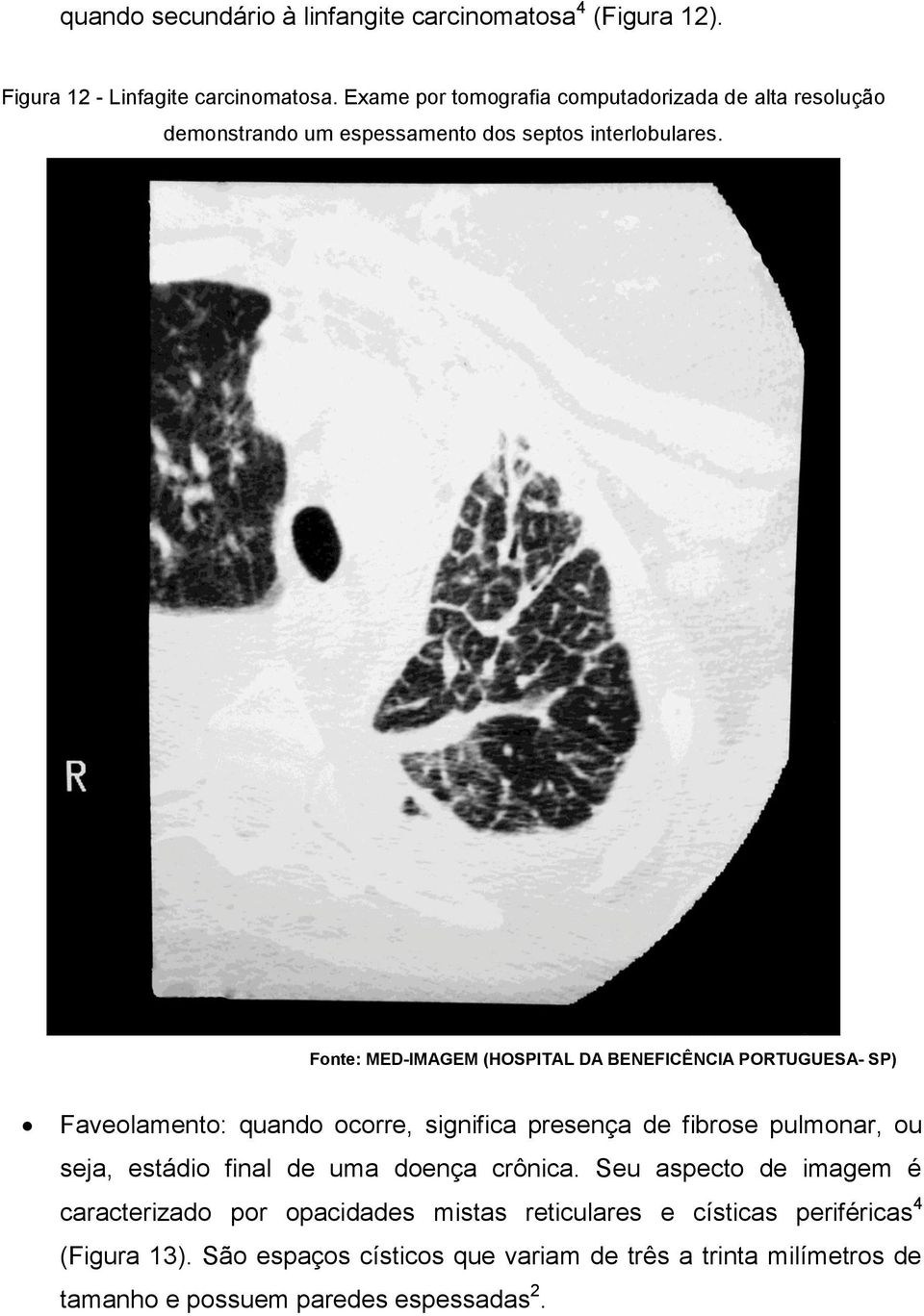 Fonte: MED-IMAGEM (HOSPITAL DA BENEFICÊNCIA PORTUGUESA- SP) Faveolamento: quando ocorre, significa presença de fibrose pulmonar, ou seja, estádio