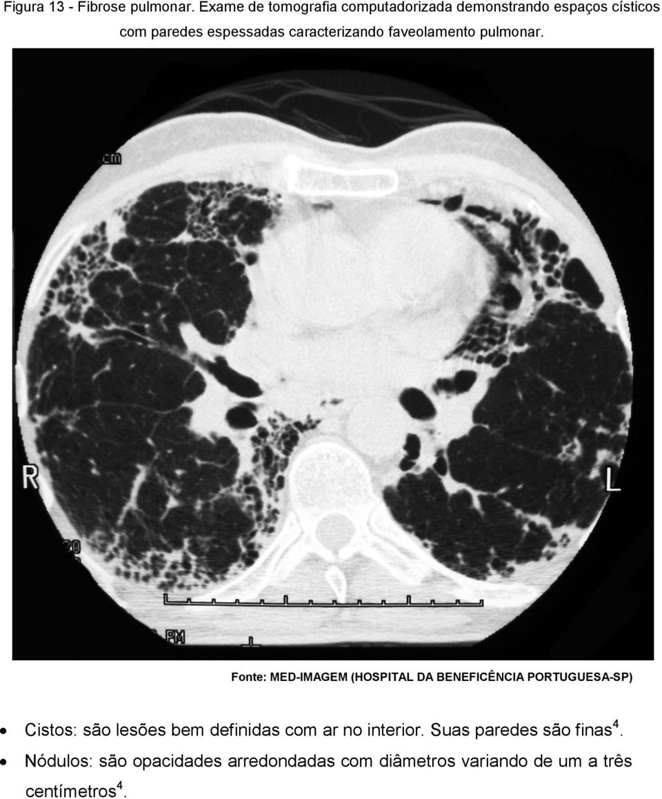 caracterizando faveolamento pulmonar.
