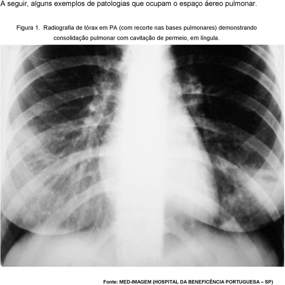 Radiografia de tórax em PA (com recorte nas bases pulmonares)