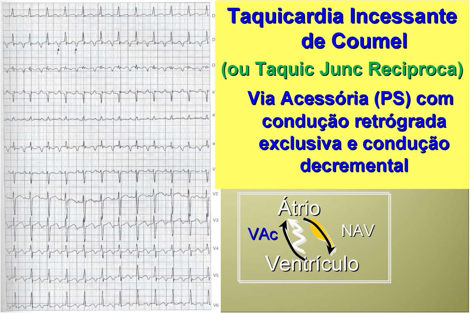 Acessória (PS) com conduçã ção o