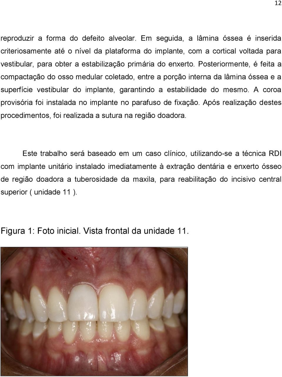 Posteriormente, é feita a compactação do osso medular coletado, entre a porção interna da lâmina óssea e a superfície vestibular do implante, garantindo a estabilidade do mesmo.