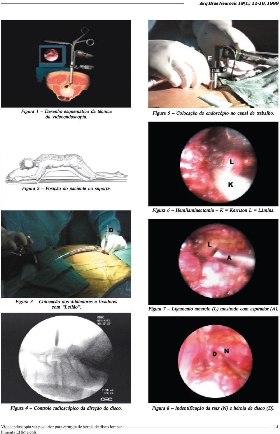 Figura 6 Hemilaminectomia K = Kerrison L = Lâmina. Figura 3 Colocação dos dilatadores e fixadores com Leilão.