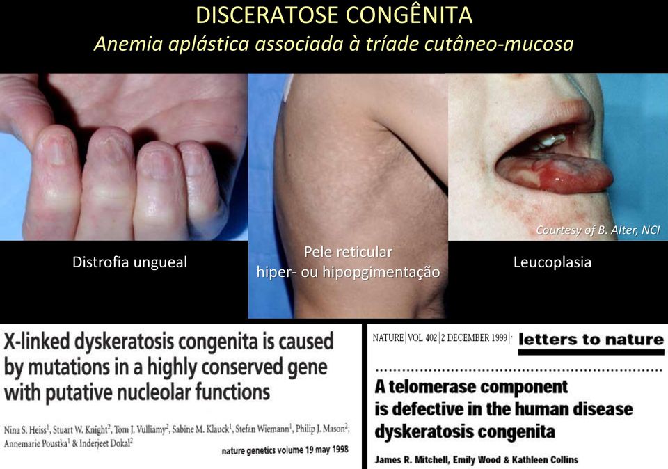 Distrofia ungueal Pele reticular hiper- ou