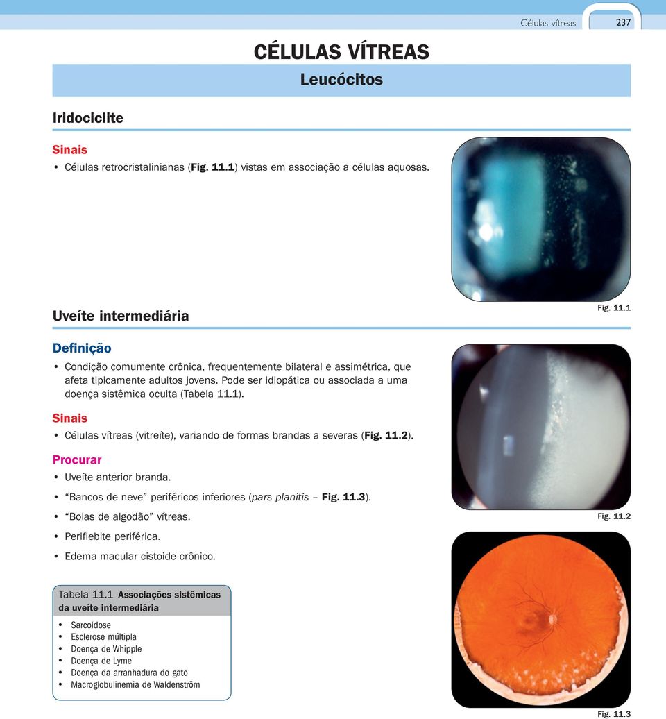 Pode ser idiopática ou associada a uma doença sistêmica oculta (Tabela 11.1). Células vítreas (vitreíte), variando de formas brandas a severas (Fig. 11.2). Procurar Uveíte anterior branda.