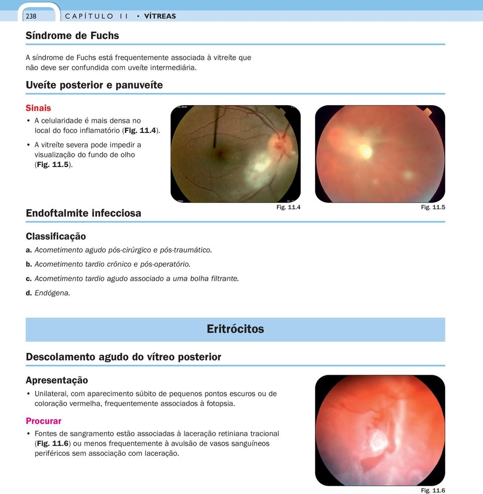 Endoftalmite infecciosa Fig. 11.4 Fig. 11.5 Classificação a. Acometimento agudo pós-cirúrgico e pós-traumático. b. Acometimento tardio crônico e pós-operatório. c. Acometimento tardio agudo associado a uma bolha filtrante.