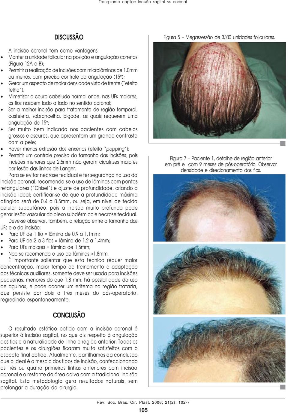 0mm ou menos, com preciso controle da angulação (15 ); Gerar um aspecto de maior densidade visto de frente ( efeito telha ); Mimetizar o couro cabeludo normal onde, nas UFs maiores, os fios nascem