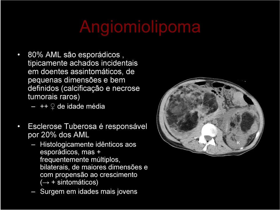 Tuberosa é responsável por 20% dos AML Histologicamente idênticos aos esporádicos, mas + frequentemente