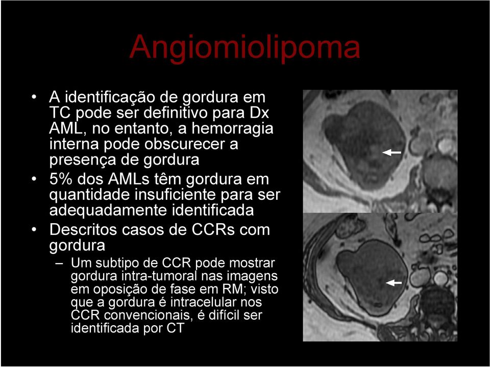 identificada Descritos casos de CCRs com gordura Um subtipo de CCR pode mostrar gordura intra-tumoral nas imagens