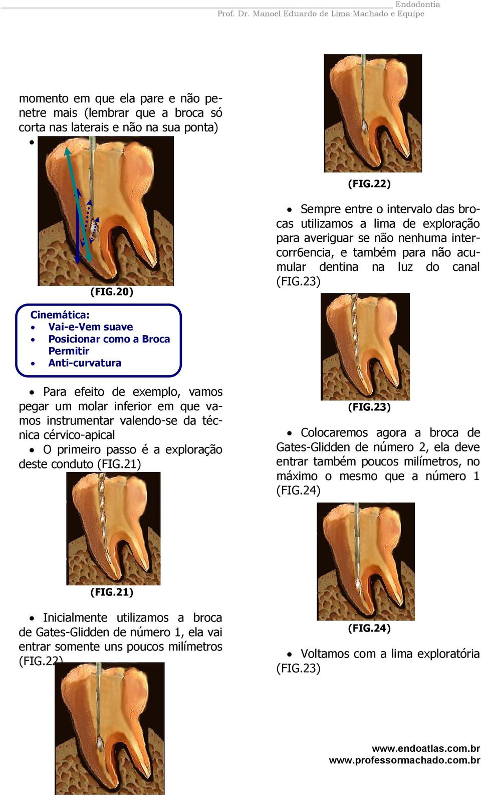 Posicionar como a Broca Permitir Anti-curvatura Para efeito de exemplo, vamos pegar um molar inferior em que vamos instrumentar valendo-se da técnica cérvico-apical O primeiro passo é a exploração