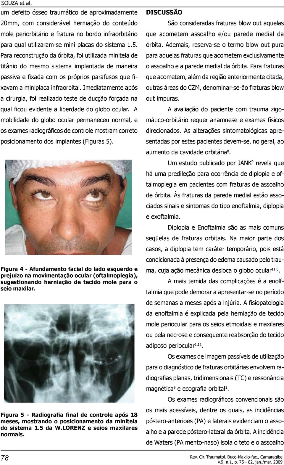 Para reconstrução da órbita, foi utilizada minitela de titânio do mesmo sistema implantada de maneira passiva e fixada com os próprios parafusos que fixavam a miniplaca infraorbital.