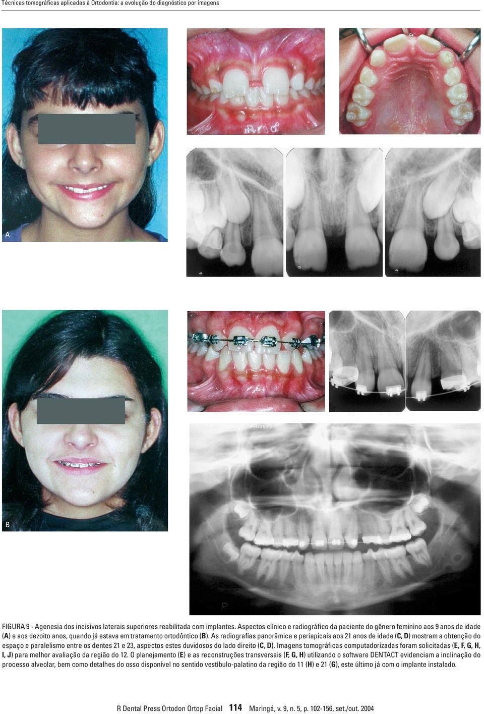 As radiografias panorâmica e periapicais aos 21 anos de idade (C, D) mostram a obtenção do espaço e paralelismo entre os dentes 21 e 23, aspectos estes duvidosos do lado direito (C, D).