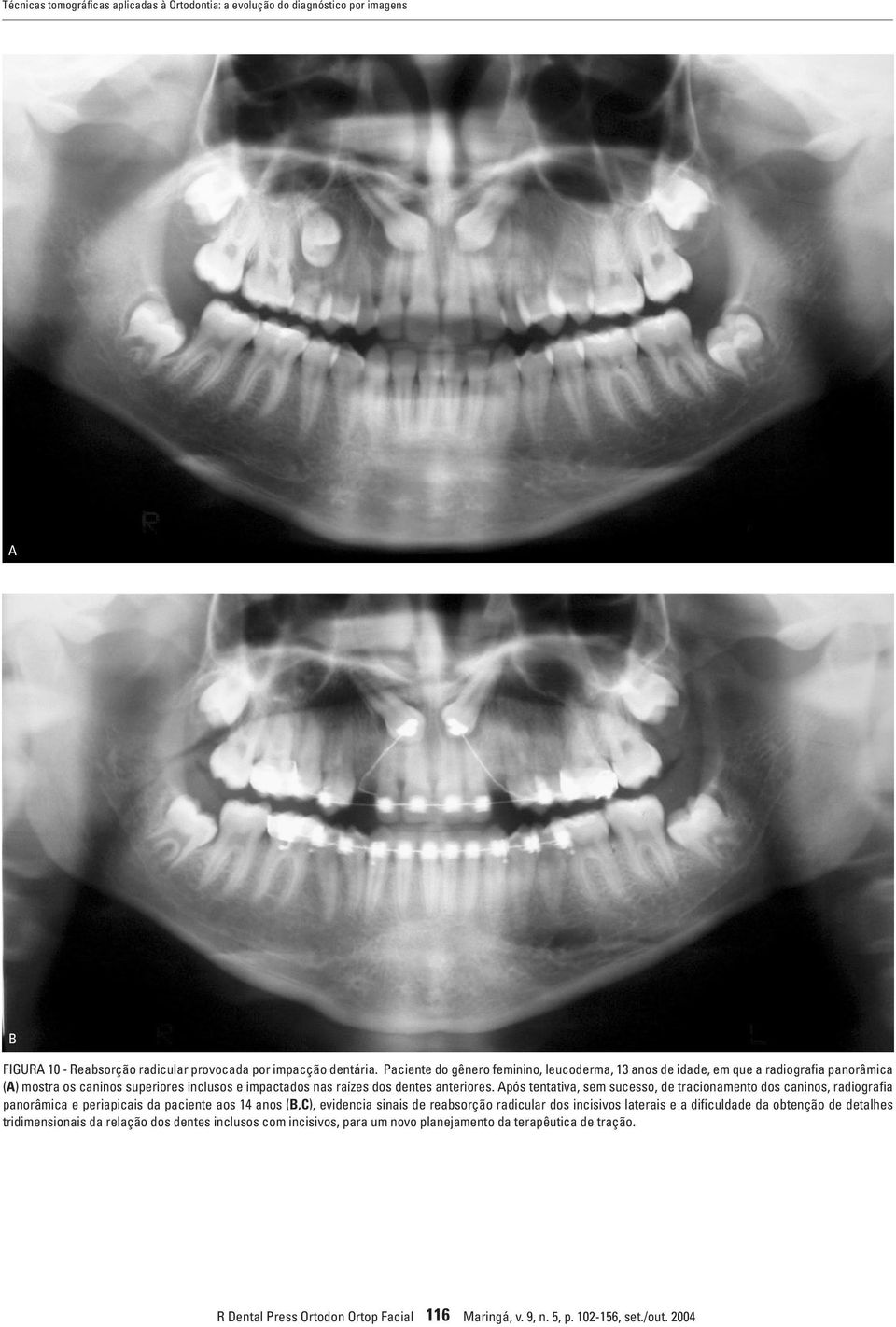 Após tentativa, sem sucesso, de tracionamento dos caninos, radiografia panorâmica e periapicais da paciente aos 14 anos (B,C), evidencia sinais de reabsorção radicular dos incisivos laterais