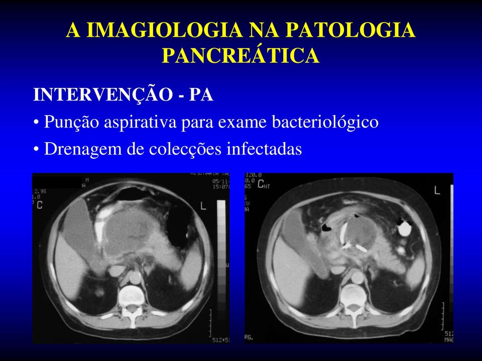 bacteriológico Drenagem