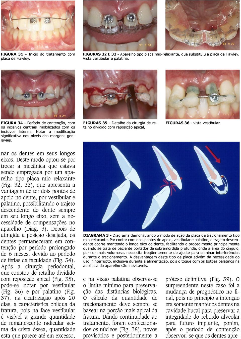 FIGURAS 35 - Detalhe da cirurgia de retalho dividido com reposição apical, FIGURAS 36 - vista vestibular. nar os dentes em seus longos eixos.