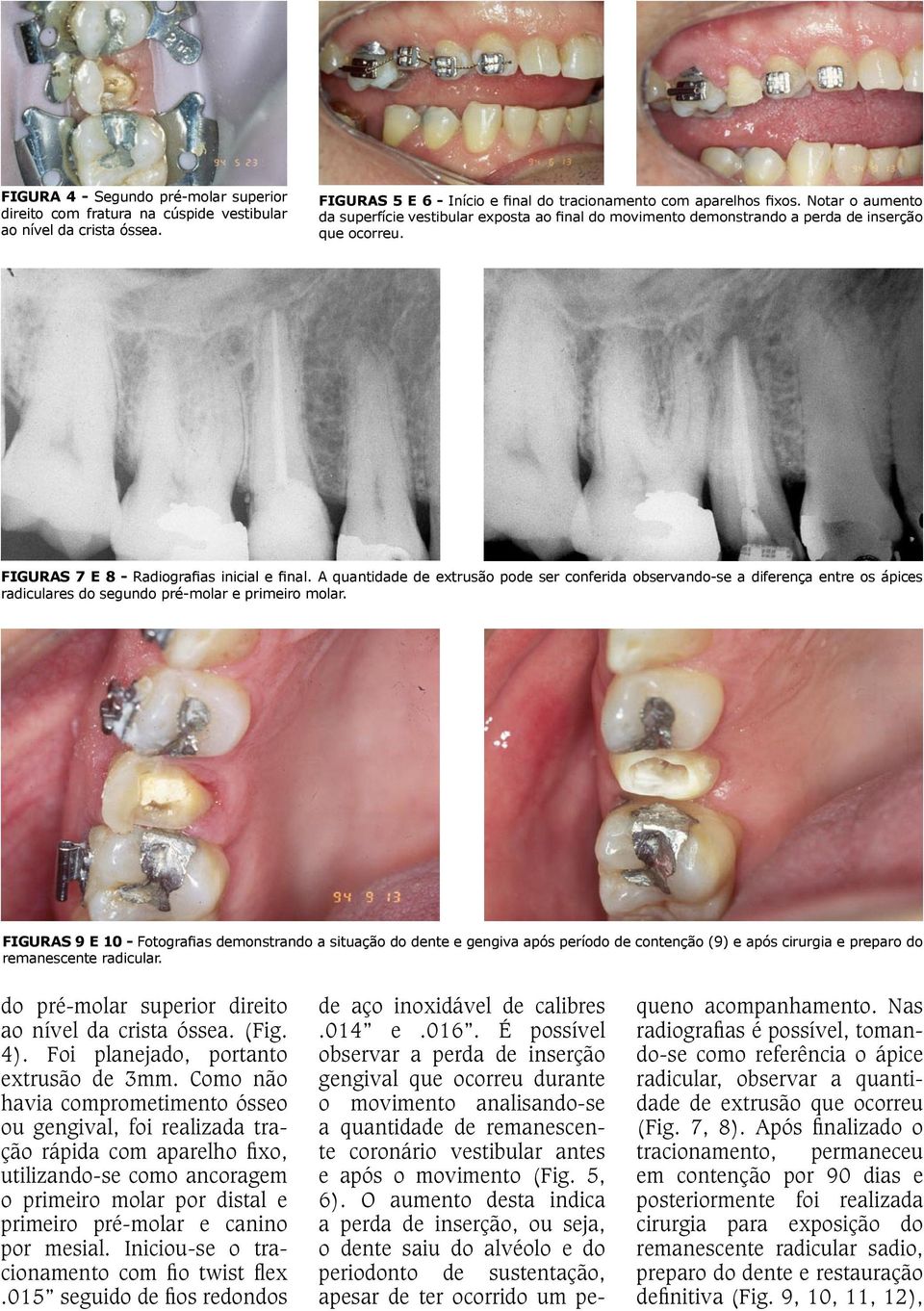 A quantidade de extrusão pode ser conferida observando-se a diferença entre os ápices radiculares do segundo pré-molar e primeiro molar.