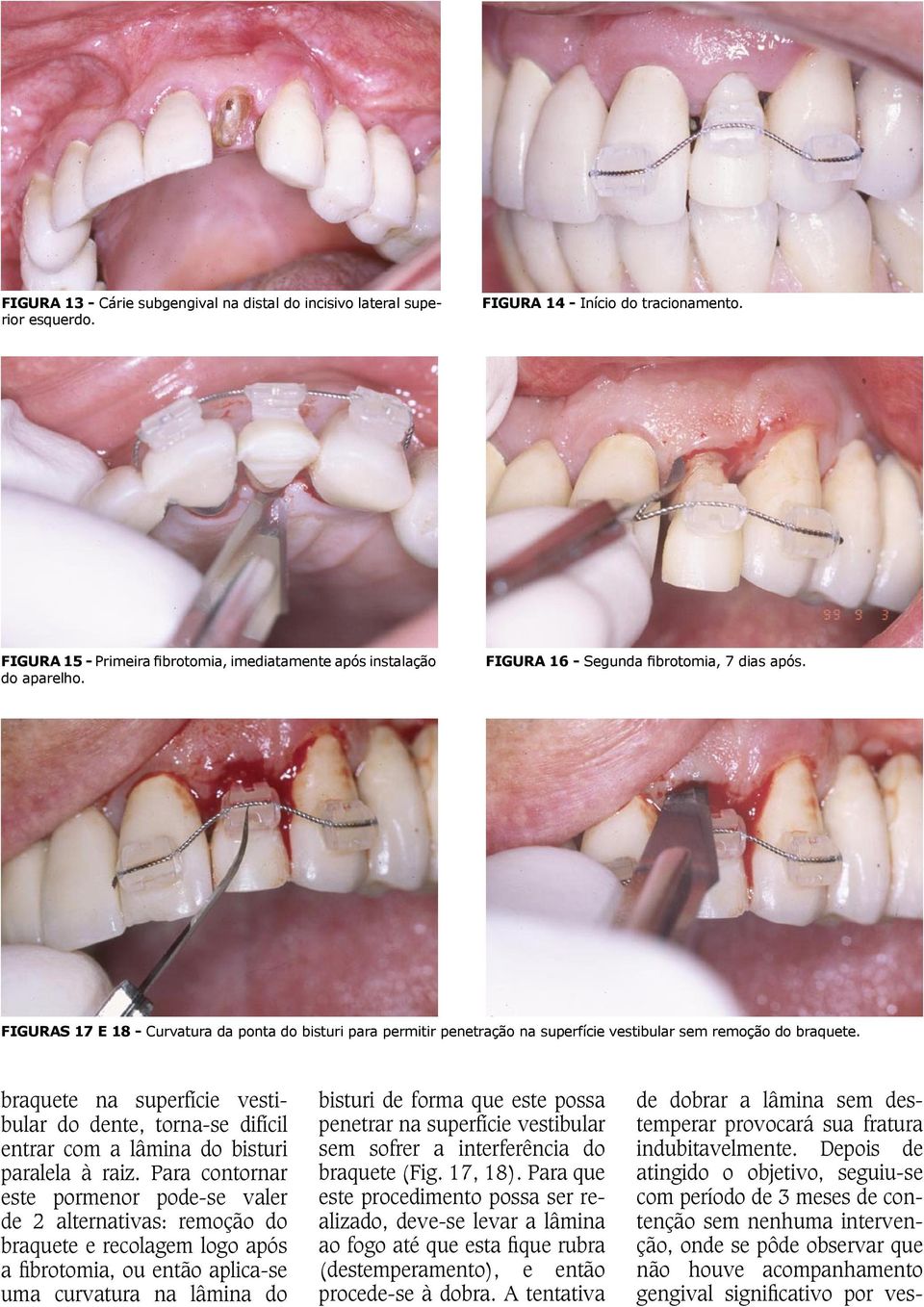 braquete na superfície vestibular do dente, torna-se difícil entrar com a lâmina do bisturi paralela à raiz.