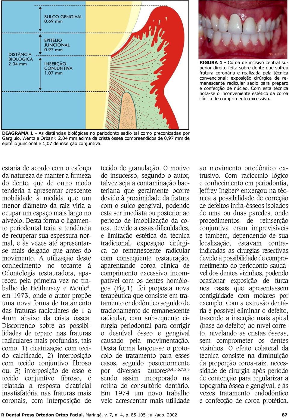 DIAGRAMA 1 - As distâncias biológicas no periodonto sadio tal como preconizadas por Gargiulo, Wentz e Orban 1 : 2,04 mm acima da crista óssea compreendidos de 0,97 mm de epitélio juncional e 1,07 de