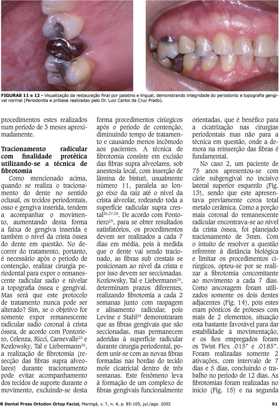 Tracionamento radicular com finalidade protética utilizando-se a técnica de fibrotomia Como mencionado acima, quando se realiza o tracionamento do dente no sentido oclusal, os tecidos periodontais,