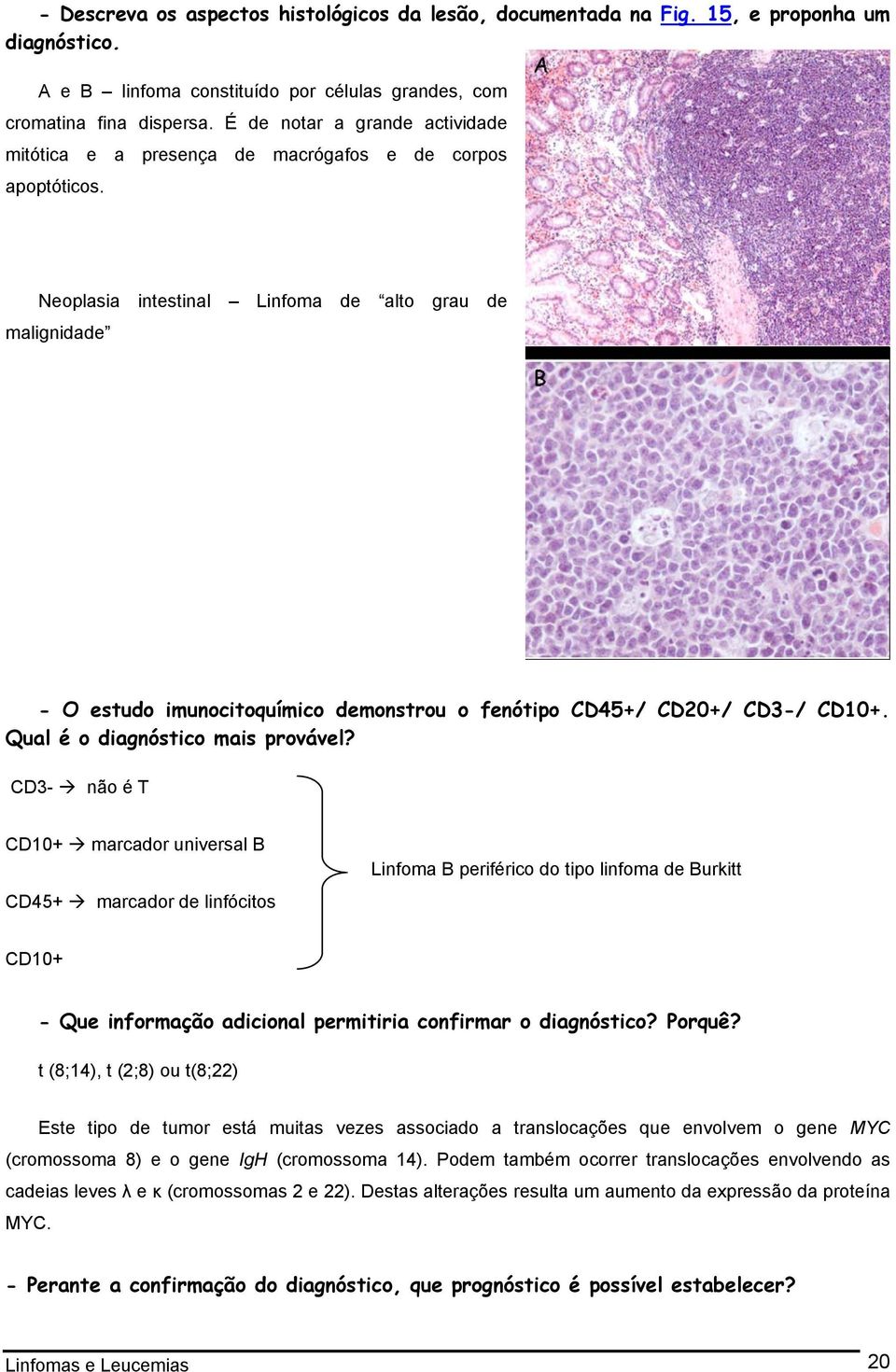 Neoplasia intestinal Linfoma de alto grau de malignidade - O estudo imunocitoquímico demonstrou o fenótipo CD45+/ CD20+/ CD3-/ CD10+. Qual é o diagnóstico mais provável?