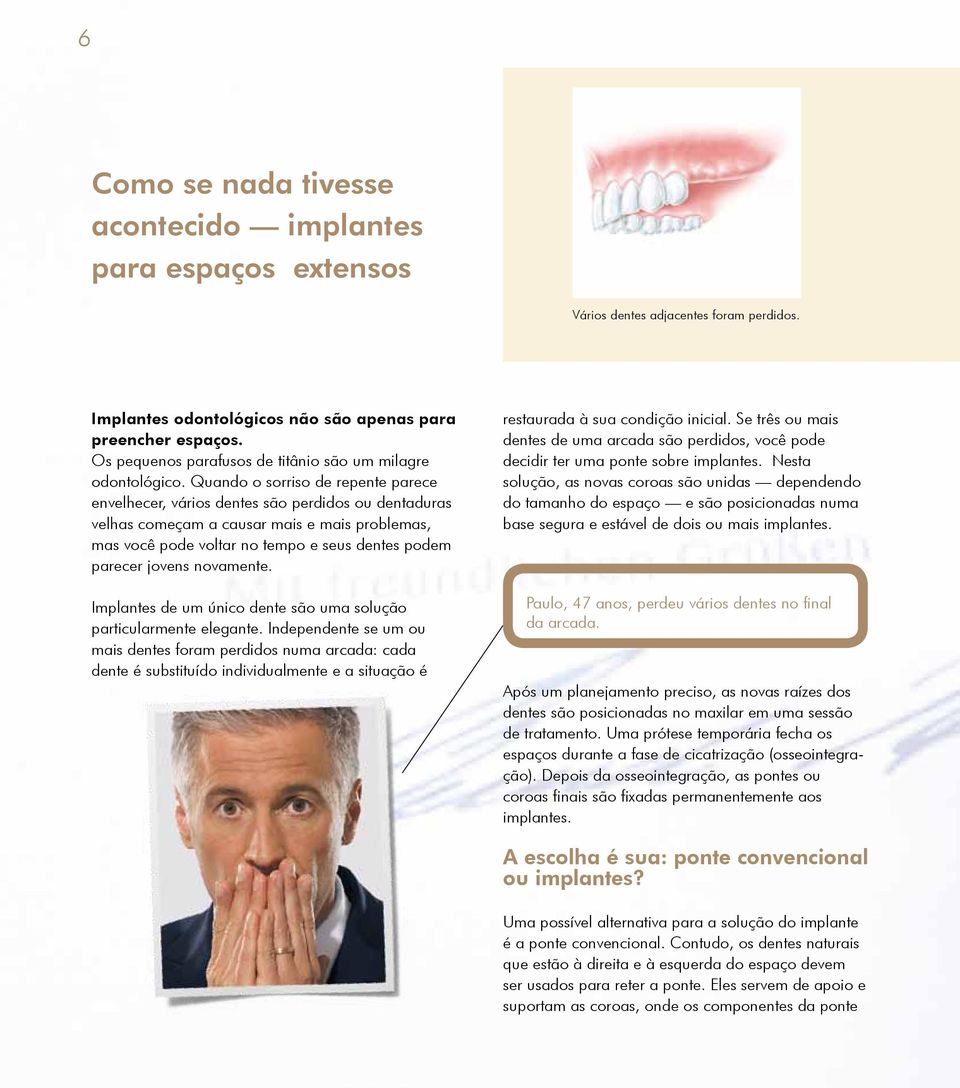 Quando o sorriso de repente parece envelhecer, vários dentes são perdidos ou dentaduras velhas começam a causar mais e mais problemas, mas você pode voltar no tempo e seus dentes podem parecer jovens