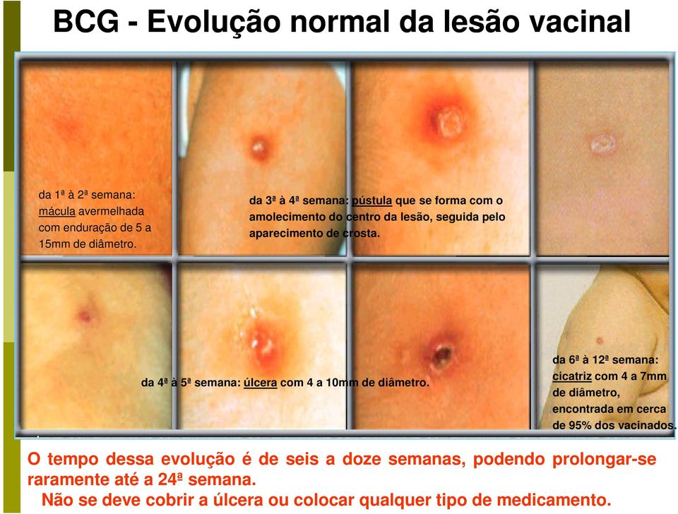 da 4ª à 5ª semana: úlcera com 4 a 10mm de diâmetro.