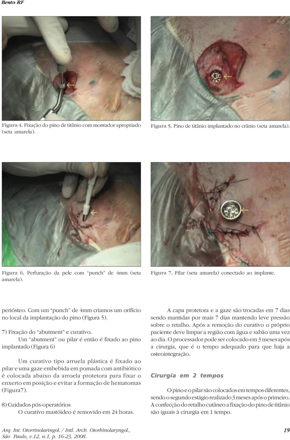 7) Fixação do abutment e curativo.