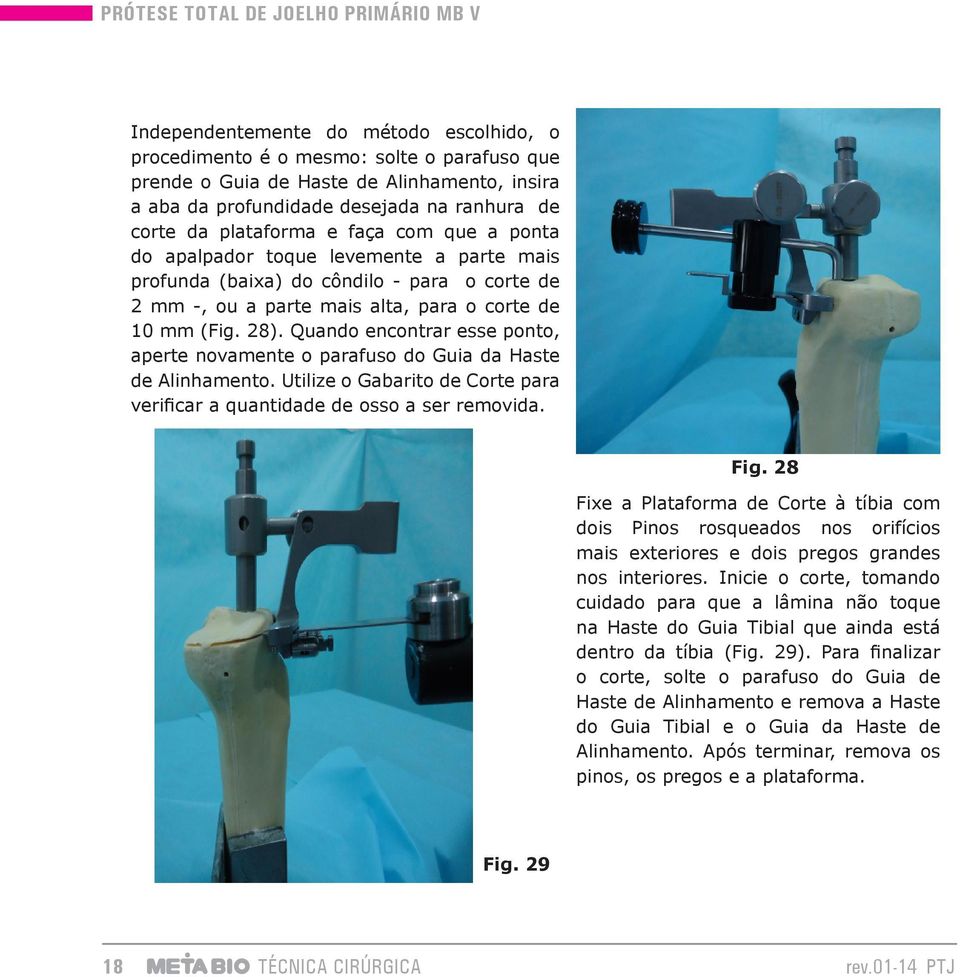 Quando encontrar esse ponto, aperte novamente o parafuso do Guia da Haste de Alinhamento. Utilize o Gabarito de Corte para verificar a quantidade de osso a ser removida. Fig.