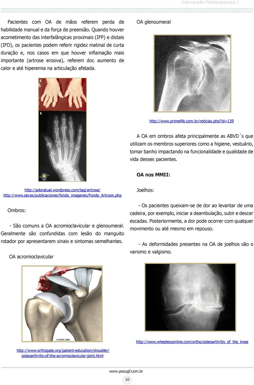 (artrose erosiva), referem dor, aumento de calor e até hiperemia na articulação afetada. OA glenoumeral http://www.primelife.com.br/noticias.php?