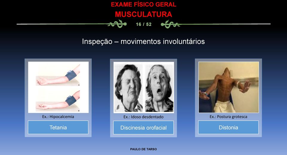 : Hipocalcemia Tetania Ex.