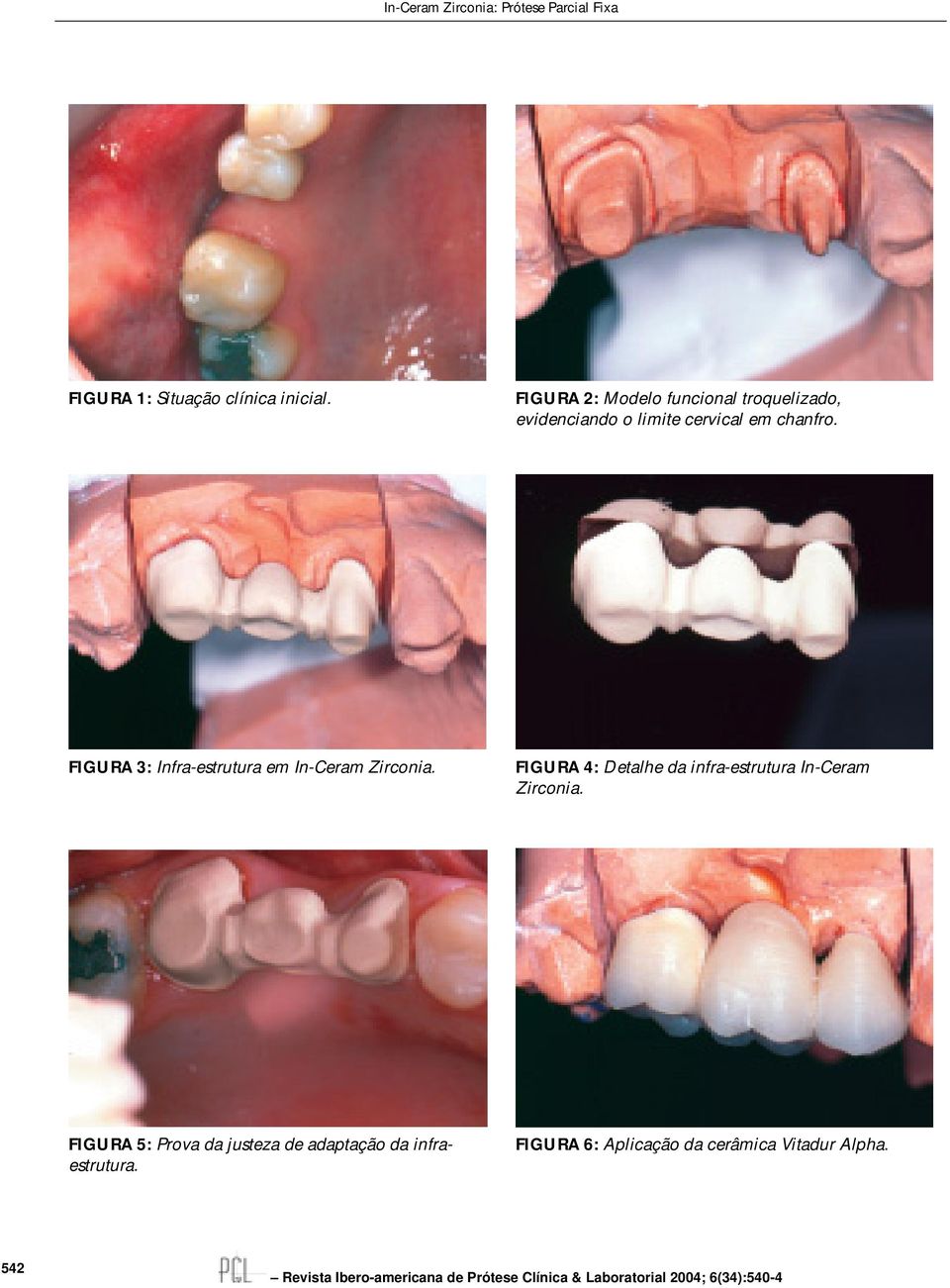 FIGURA 3: Infra-estrutura em In-Ceram Zirconia.