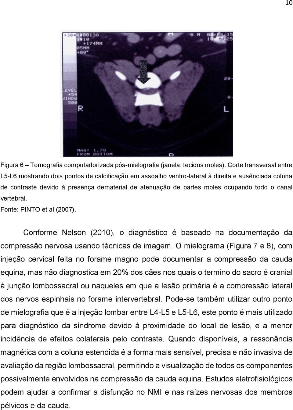 ocupando todo o canal vertebral. Fonte: PINTO et al (2007). Conforme Nelson (2010), o diagnóstico é baseado na documentação da compressão nervosa usando técnicas de imagem.