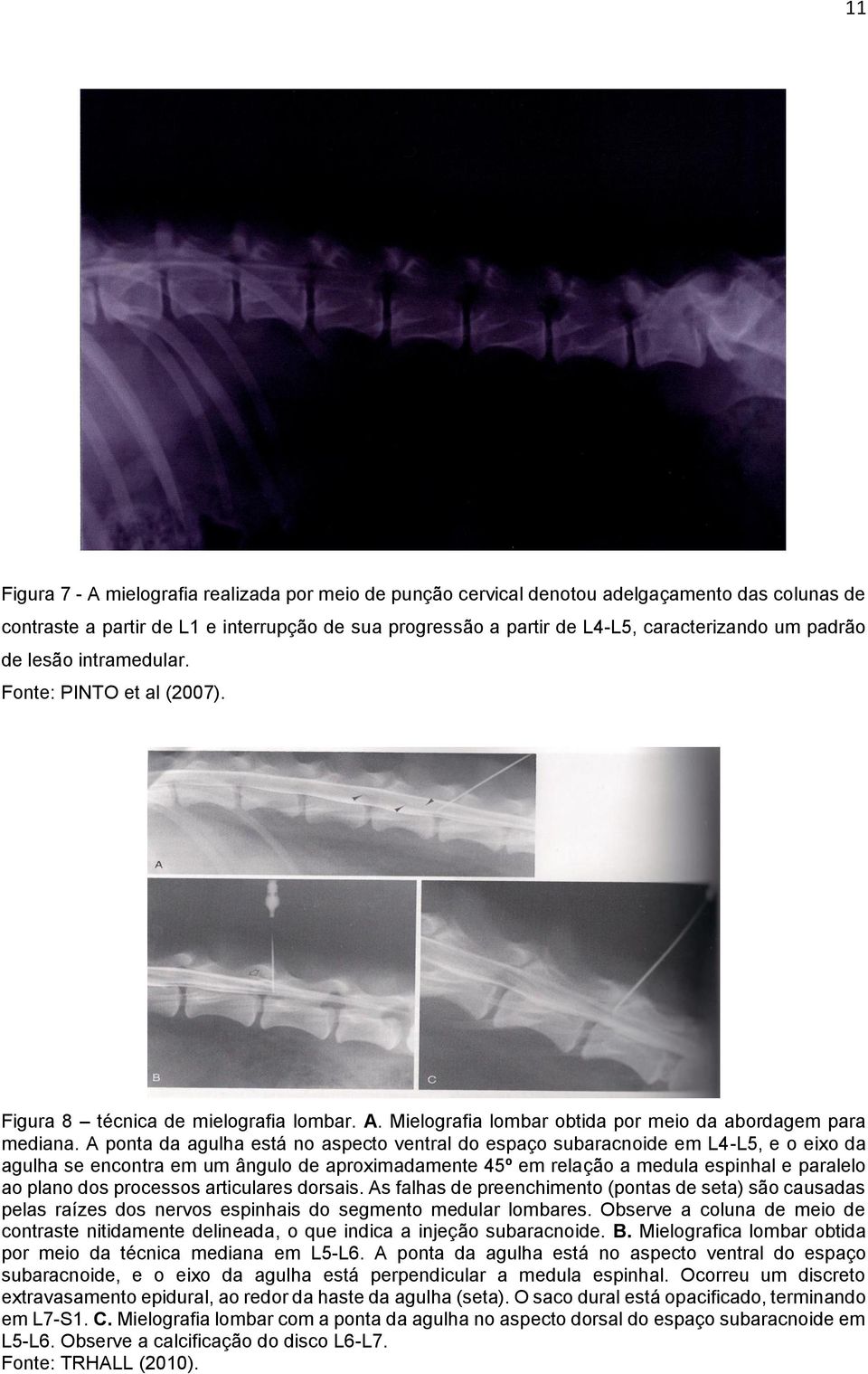 A ponta da agulha está no aspecto ventral do espaço subaracnoide em L4-L5, e o eixo da agulha se encontra em um ângulo de aproximadamente 45º em relação a medula espinhal e paralelo ao plano dos