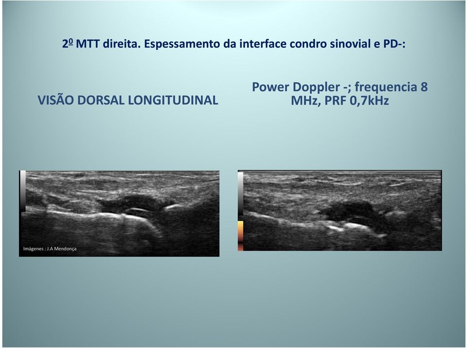 sinovial e PD : VISÃO DORSAL