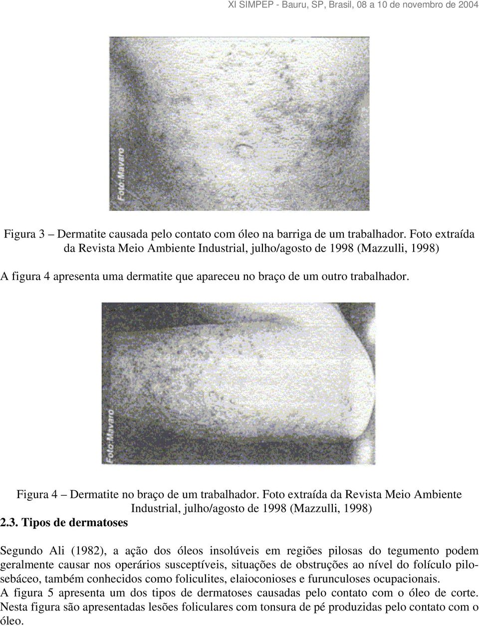 Figura 4 Dermatite no braço de um trabalhador. Foto extraída da Revista Meio Ambiente Industrial, julho/agosto de 1998 (Mazzulli, 1998) 2.3.