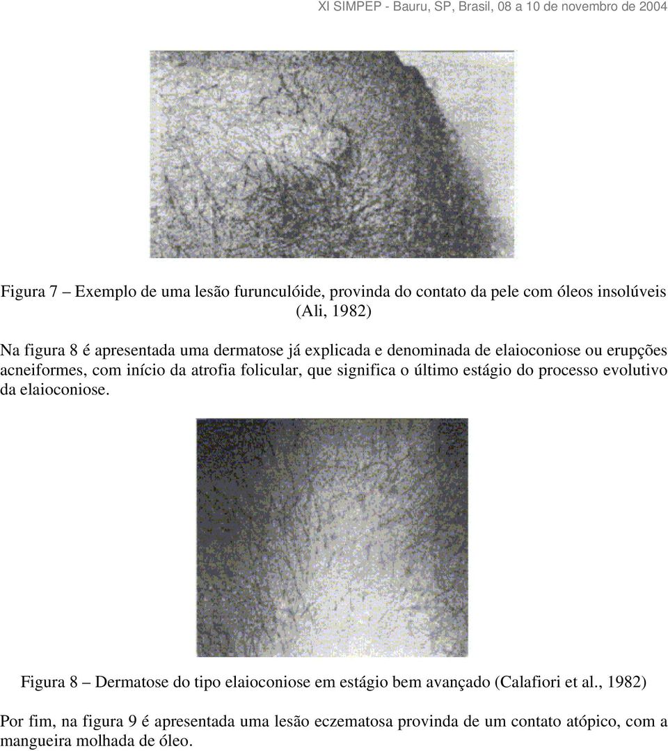 último estágio do processo evolutivo da elaioconiose.