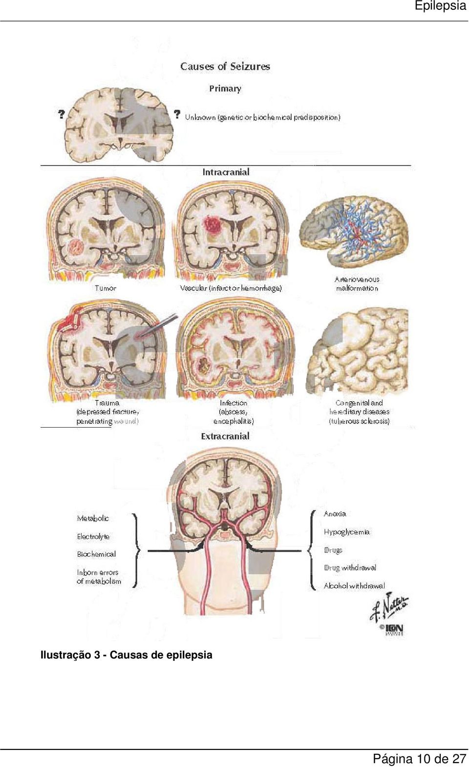 epilepsia