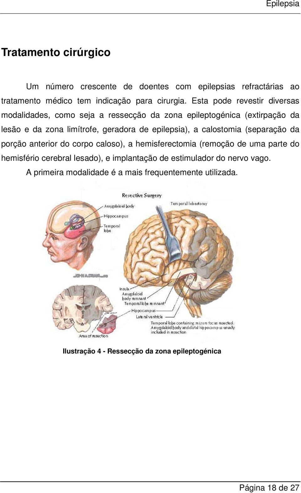 epilepsia), a calostomia (separação da porção anterior do corpo caloso), a hemisferectomia (remoção de uma parte do hemisfério cerebral lesado),