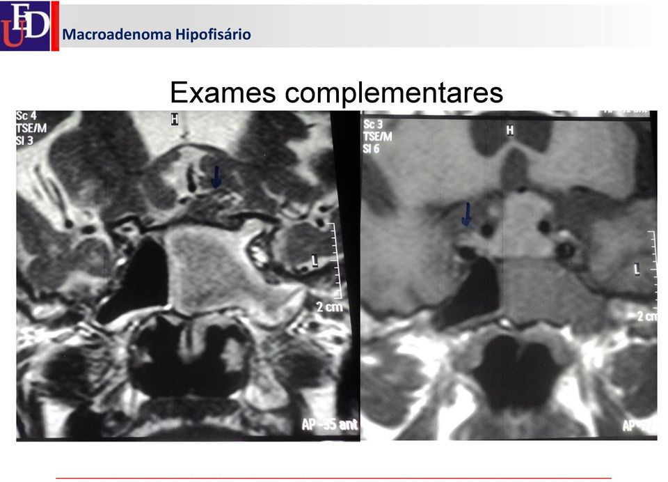 Esta lesão exerce efeito compressivo sobre o quiasma óptico que se encontra deslocado súpero-anteriormente.