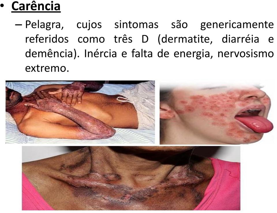 (dermatite, diarréia e demência).