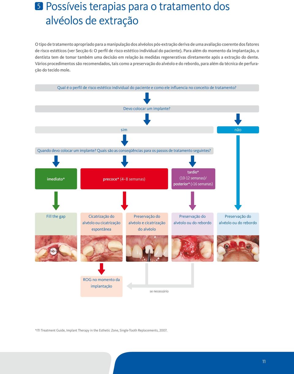 Para além do momento da implantação, o dentista tem de tomar também uma decisão em relação às medidas regenerativas diretamente após a extração do dente.