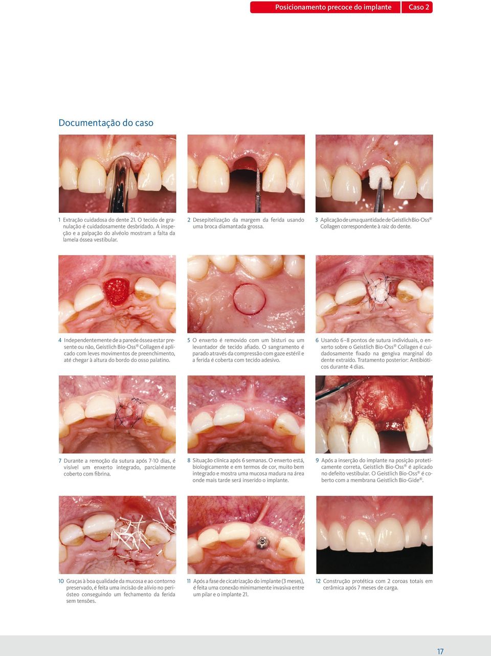 3 Aplicação de uma quantidade de Geistlich Bio-Oss Collagen correspondente à raiz do dente.