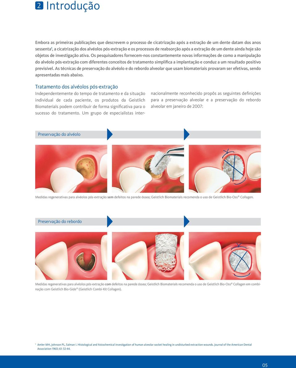 Os pesquisadores fornecem-nos constantemente novas informações de como a manipulação do alvéolo pós-extração com diferentes conceitos de tratamento simplifica a implantação e conduz a um resultado