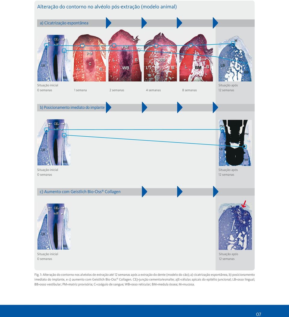 1: Alteração do contorno nos alvéolos de extração até 12 semanas após a extração do dente (modelo do cão); a) cicatrização espontânea, b) posicionamento imediato do implante, e c) aumento com